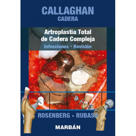 CADERA COMPLEJA ARTROPLASTIA TOTAL-MARBAN-UNIVERSAL BOOKS