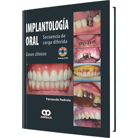 Implantologia Oral - Secuencia de Carga Diferida-amolca-UNIVERSAL BOOKS